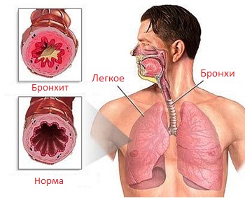 Бронхит Бронхит