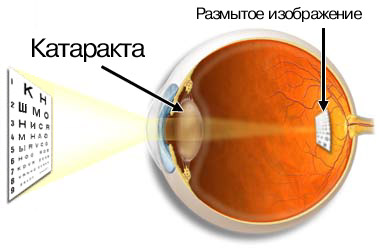 Катаракта Катаракта