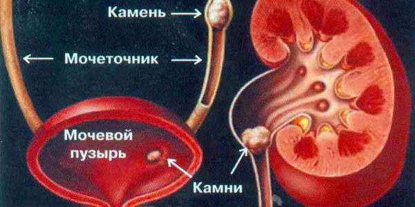 Мочекаменная болезнь Мочекаменная болезнь