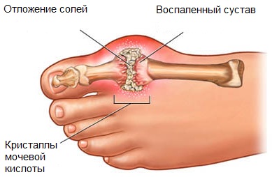 Подагра Подагра