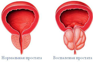 Простатит Простатит