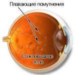 стекловидное-тело-лечение-в-интернете