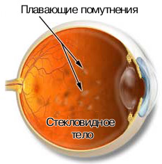 Стекловидное тело Стекловидное тело