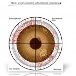 эрозия-роговицы-лечение-в-интернете