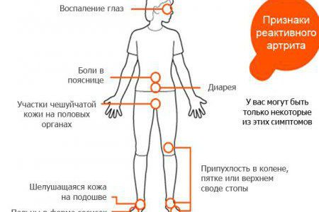 Болезнь Рейтера Болезнь Рейтера