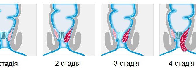 Геморрой Геморрой