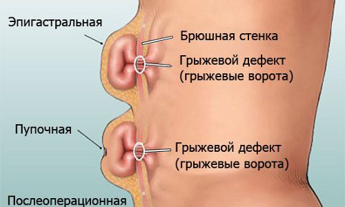 Грыжа Грыжа