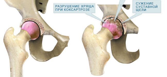 Коксартроз Коксартроз