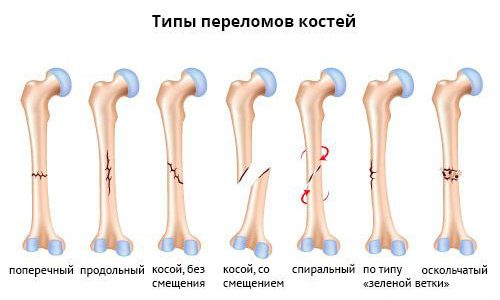 Переломы Переломы