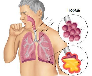 Пневмония Пневмония