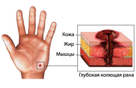 Раны Раны