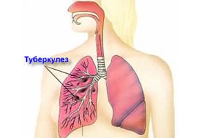 Туберкулез Туберкулез