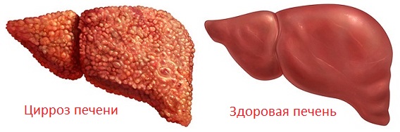 Цирроз печени Цирроз печени